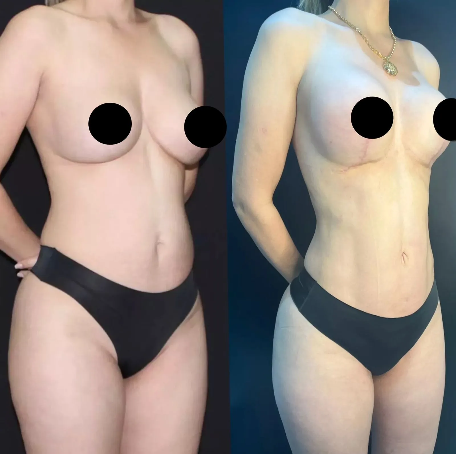 Antes e depois de Mastopexia em L na Unique